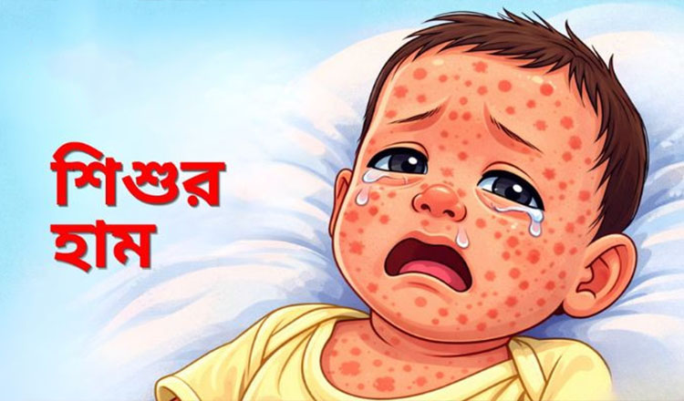 হাম পরিস্থিতি উদ্বেগজনক, মৃত্যু বেড়ে ১০, আক্রান্ত ১,১৬৬
